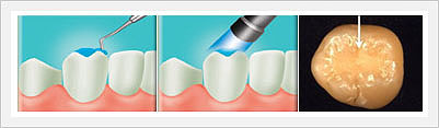 Nano Dental Fillers YbF3