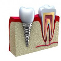 Implant